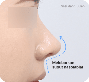 CASE 1. Sudut Nasolabial Sempit after