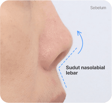 CASE 2. Sudut Nasolabial Lebar before