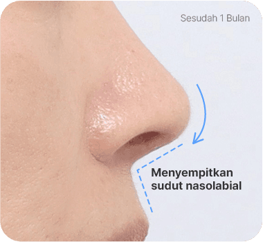 CASE 2. Sudut Nasolabial Lebar after
