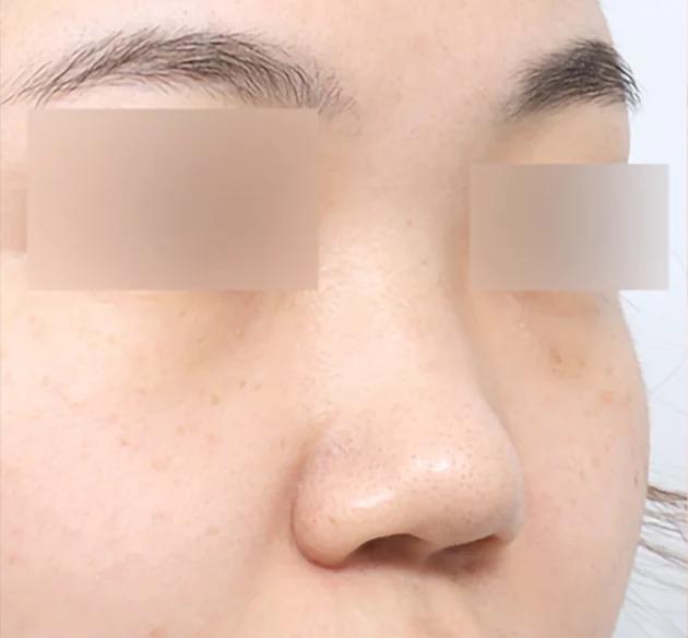 Batang hidung natural. before
