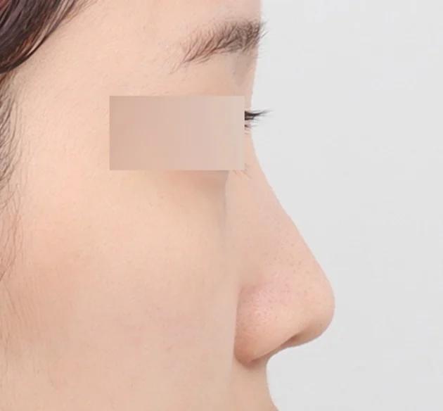 Bentuk hidung naturglow personal before