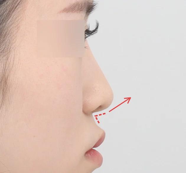 Sudut nasolabial untuk
kesan elegan dan berdimensi before