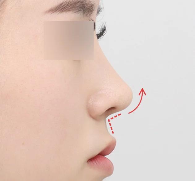 Sudut nasolabial untuk
kesan elegan dan berdimensi after