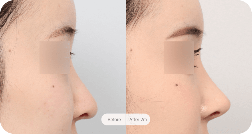 revision-rhinoplasty