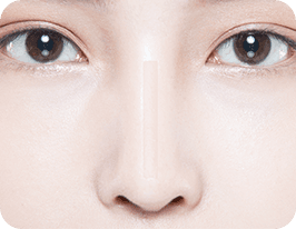 revision-rhinoplasty