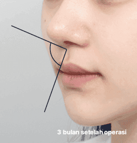 Tampilan samping yang harmonis dengan sudut nasolabial dan rongga yang seimbang