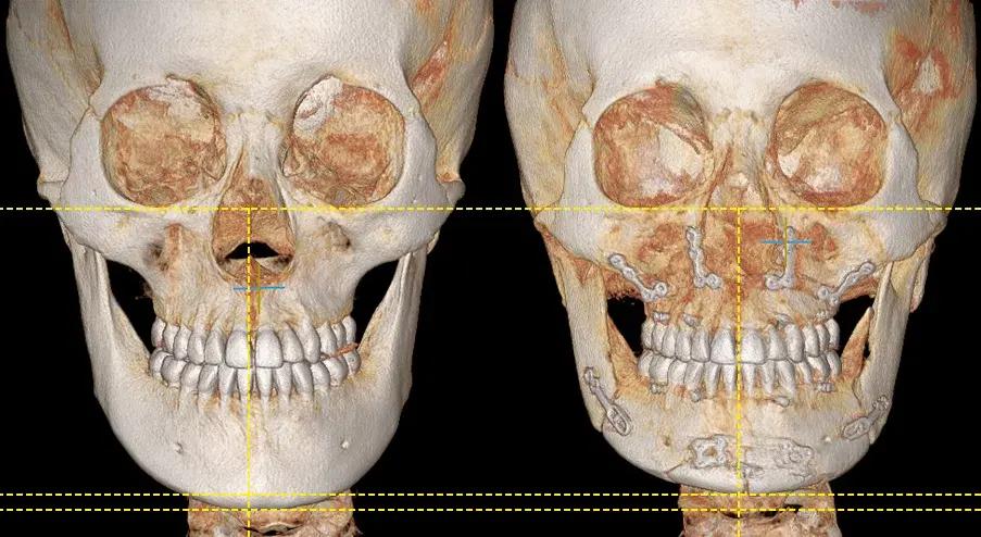 Orthognathic surgery 3D-CT before and after