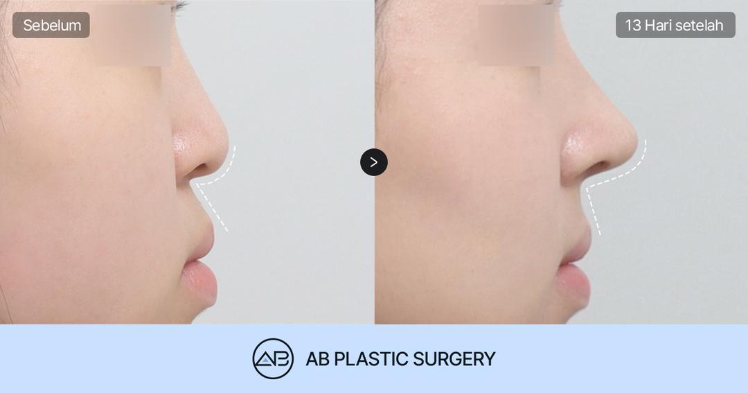 Operasi Ujung Hidung: Pentingnya Koreksi Columella dan Sudut Nasolabial untuk Hasil Natural