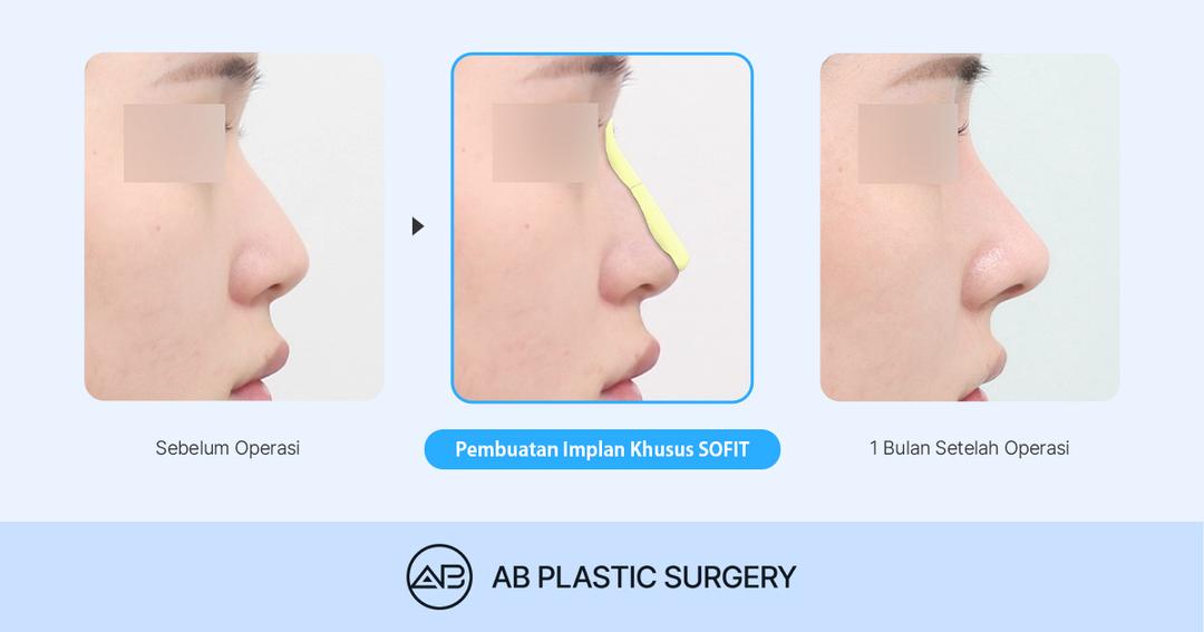Implan Hidung Kustom SOFIT: Bedanya dengan Implan Biasa