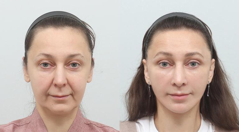 Full Face lifting,Neck lifting,Submentoplasty,Sedot lemak wajah [Double chin],Sedot lemak wajah [Garis rahang],Fat Grafting [Wajah],Lifting & Pengecilan Dahi,Pengecilan Filtrum 