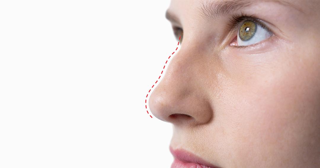 Apakah Hidung Punuk (Hump Nose) Bisa Dikoreksi Tanpa Operasi?