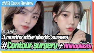 [Plastic Surgery in Korea] I'll show you how to be pretty?│review of plastic surgery