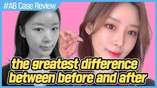 [Plastic Surgery in Korea] How to be pretty naturally│review of plastic surgery