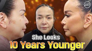 [Facelift Korea] 10 Years Younger After Facelift in Korea [Part 2]
