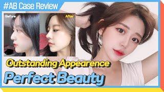 [Plastic Surgery in Korea] My nose is so pretty!! You want to know why?│review of plastic surgery 