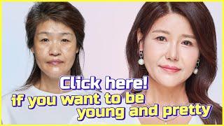 A pretty and young 20-year-old who came back #rhinoplasty #plasticsurgery #facelift