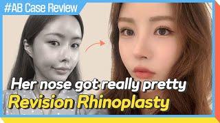 [Plastic Surgery in Korea] Successful Revision Rhinoplasty│review of plastic surgery