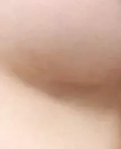 Area sayatan lipatan bawah payudara 2 bulan setelah operasi