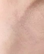 Area ketiak 
2 bulan setelah operasi