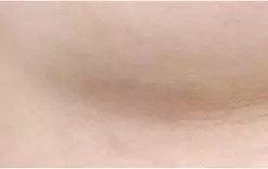 3 bulan setelah operasi