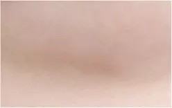 10 bulan setelah operasi