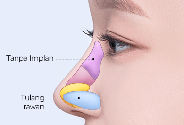 Prominent hump nose surgery — step 2