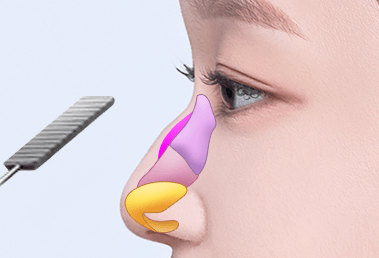 Rhinoplasty hidung punuk rendah — step 1
