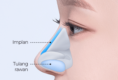 Rhinoplasty hidung punuk rendah — step 2