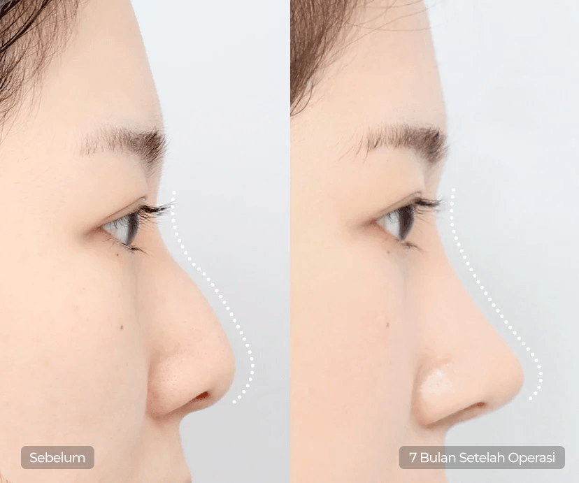 Hump Nose Rhinoplasty