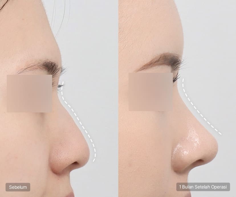 Operasi Hidung Tanpa Implan