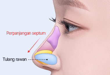 Short nose surgery — after: cartilage insertion and length extension