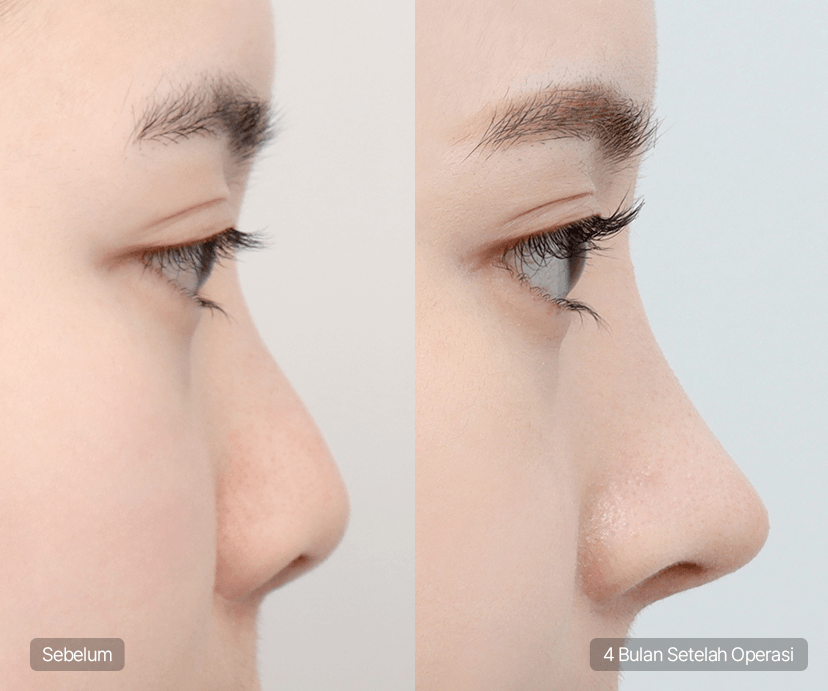 Short Nose Rhinoplasty