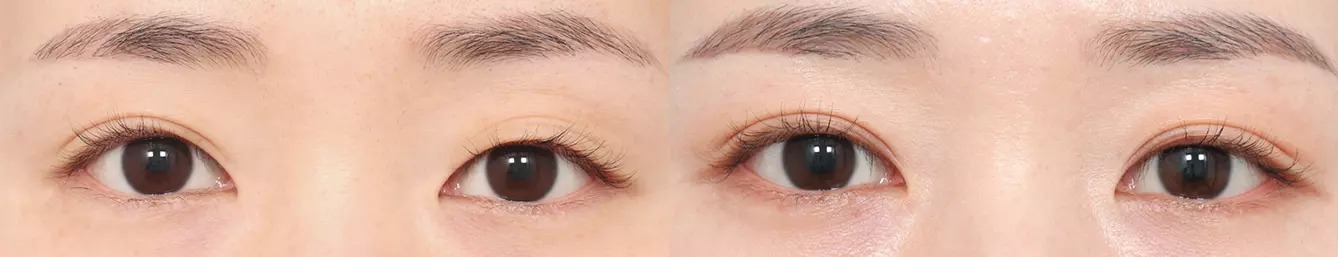 Double eyelid before and after case 2