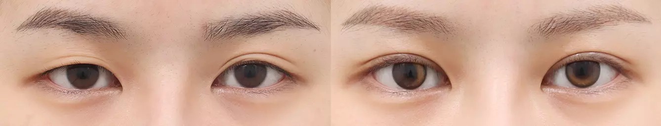 Double eyelid before and after case 4