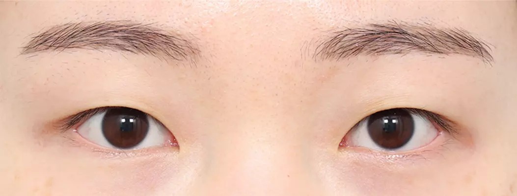 Before natural adhesion surgery