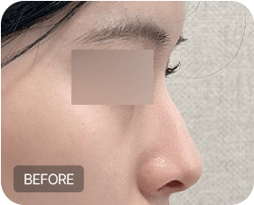 Before and after 1-1