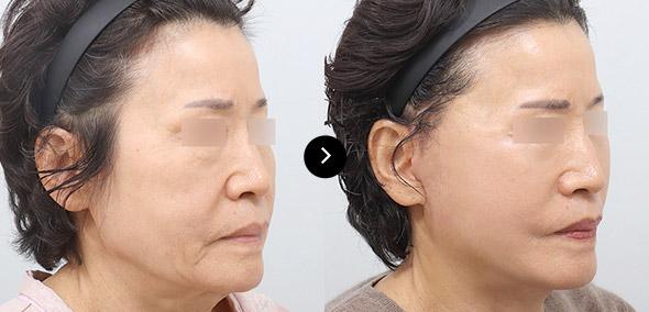 Full SMAS Lifting image 2