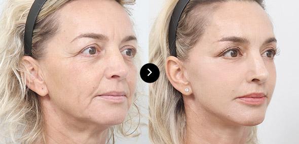 Full SMAS Lifting image 3