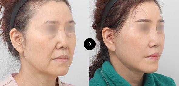 Full SMAS Lifting image 4