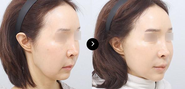 Full SMAS Lifting image 5