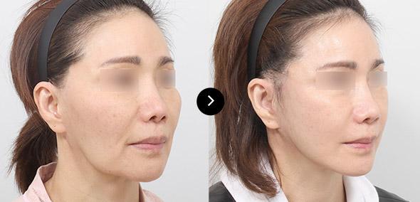 Full SMAS Lifting image 6