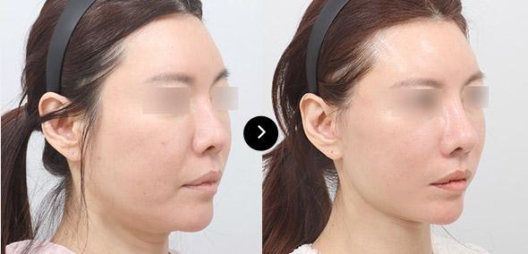 Semi Full Lifting image 1