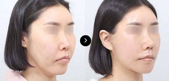 Semi Full Lifting image 2