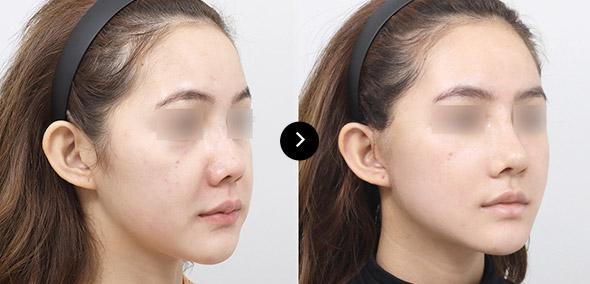 Semi Full Lifting image 3