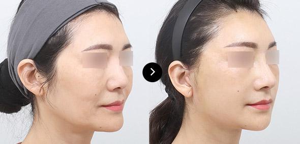 Semi Full Lifting image 4