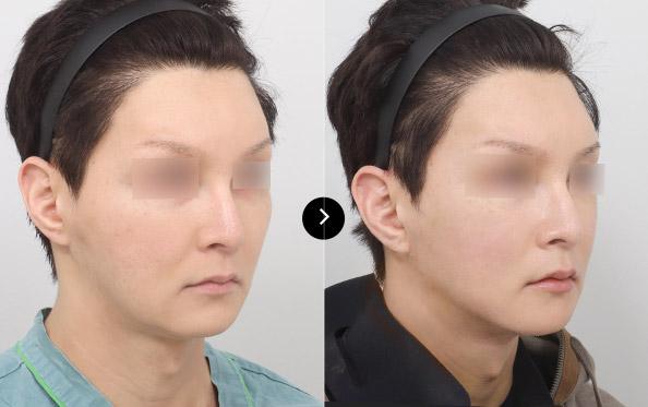 Mini Lifting image 1