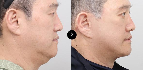 Lifting Leher image 1