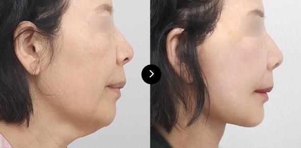 Lifting Leher image 2