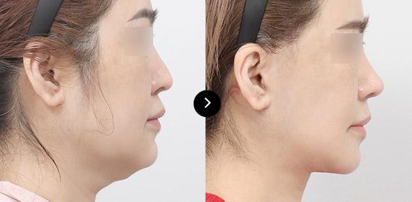 Lifting Leher image 4