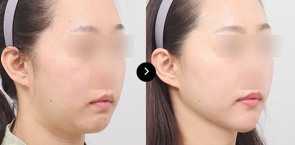 Lifting Benang Double-chin image 1